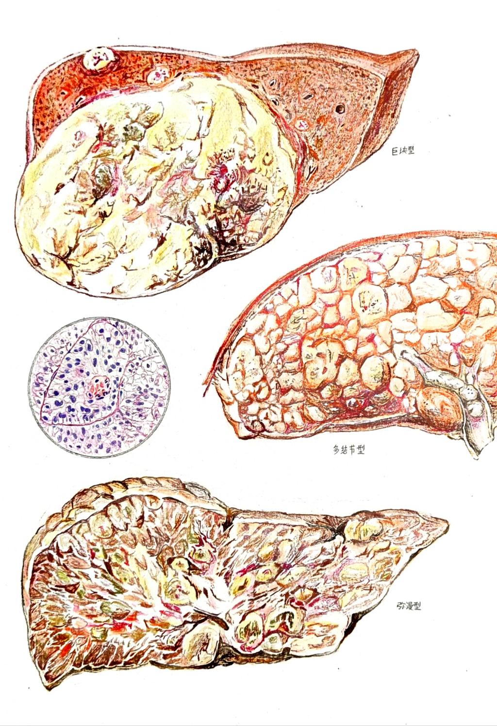 5. 邮寄手绘 作品分类 2 肝细胞癌的病理变化 91吃瓜
 韩培航